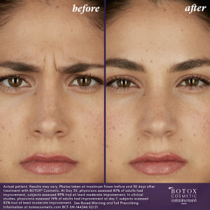 BOTOX | Qualimed Aesthetics Services