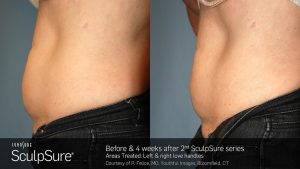 sculpsure | Qualimed Aesthetics Services