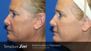 Tempsure Envi | Qualimed Aesthetics Services